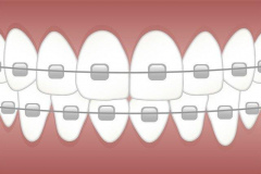 braces-3597591_640